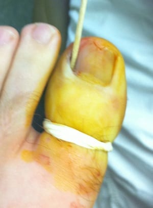 toenail ingrown surgery burn chemical outpatient toe caution graphic shoes removed quarter inch causing pain such been myfivefingers