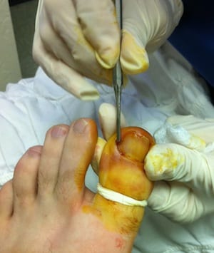 Outpatient Surgery For An Ingrown Toenail [Caution: Graphic Photos]