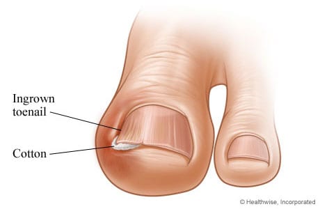 Ingrown Toenails And Other Foot Maladies