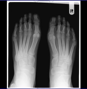 Foot Arthritis: Barefoot a Help or Hindrance?