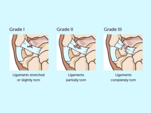 Types of Sprains 