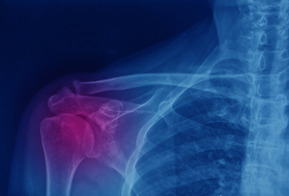 How to Recover From a Sprained Shoulder